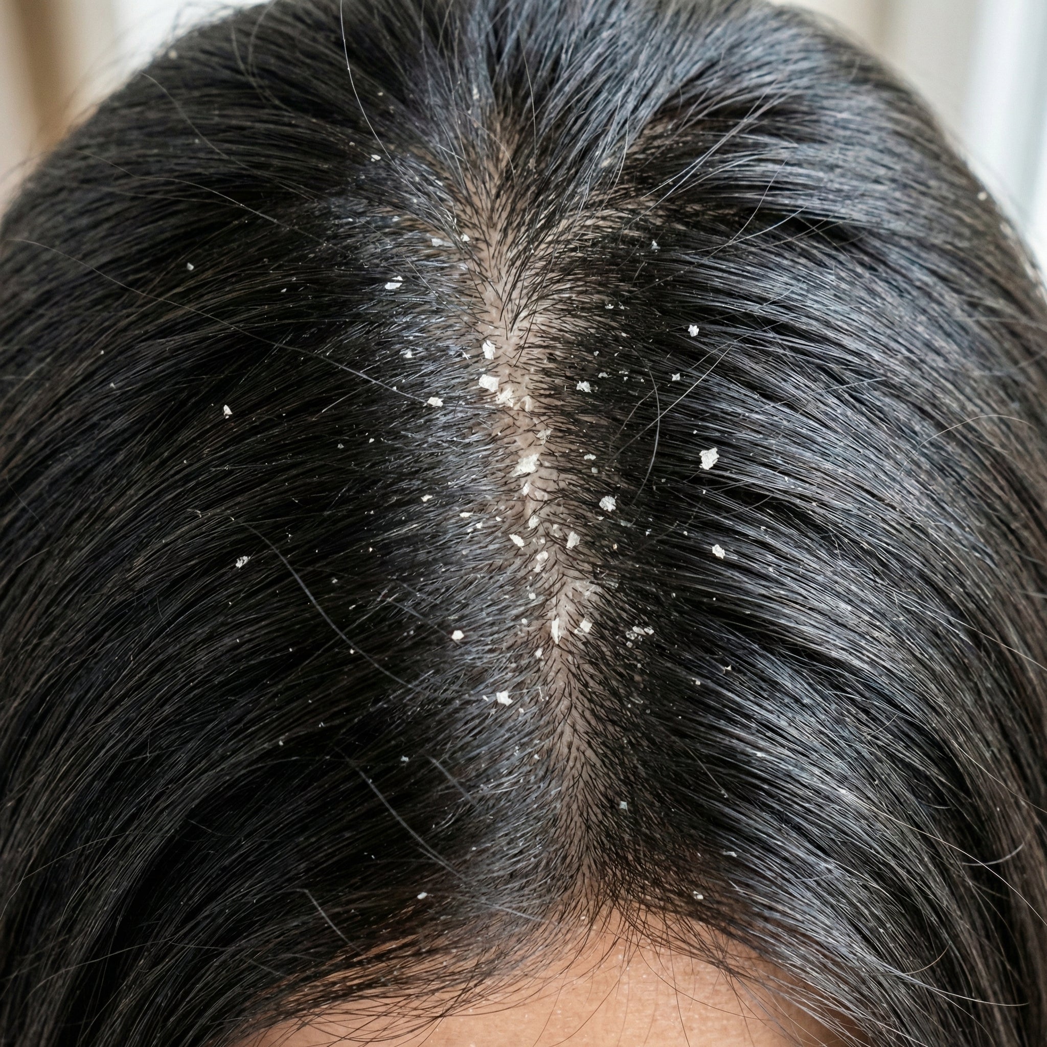 Kepek Neden Oluşur? Farkında Olmadan Yaptığınız 7 Yanlış