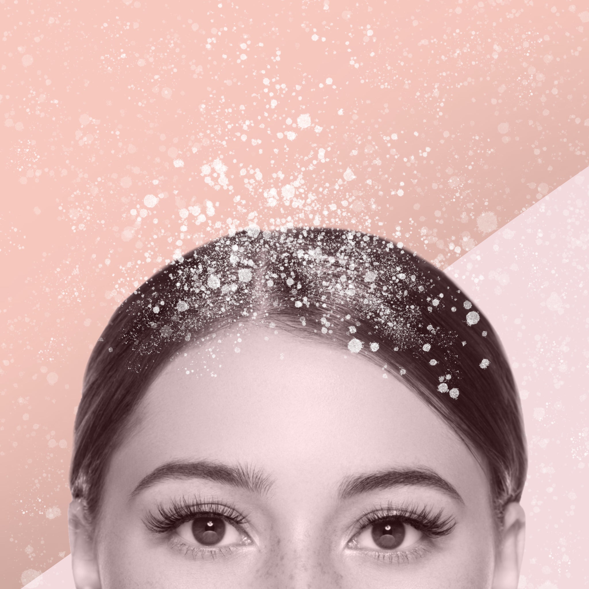 Kepek Problemim Bitmiyor! 3 Büyük Nedeni